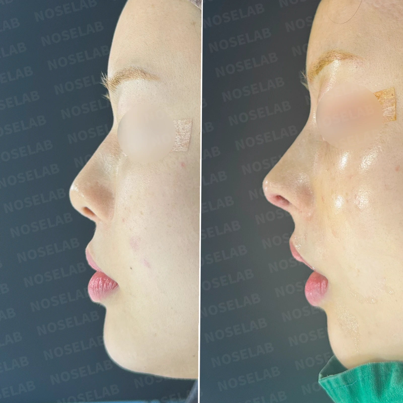 고개를 들면 콧구멍 모양이 다르고 코가 막히는 이유, 비중격 재건 방법 — 본문 사진 20