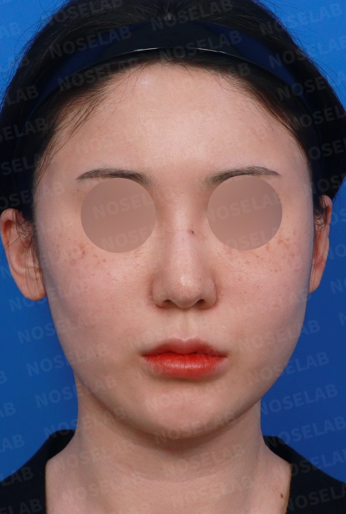길고 뭉툭한 코, 자가늑연골로 화려하면서 자연스럽게 — 디자인 상담 정면, 좌측 측면, 비스듬한 측면 사진입니다.