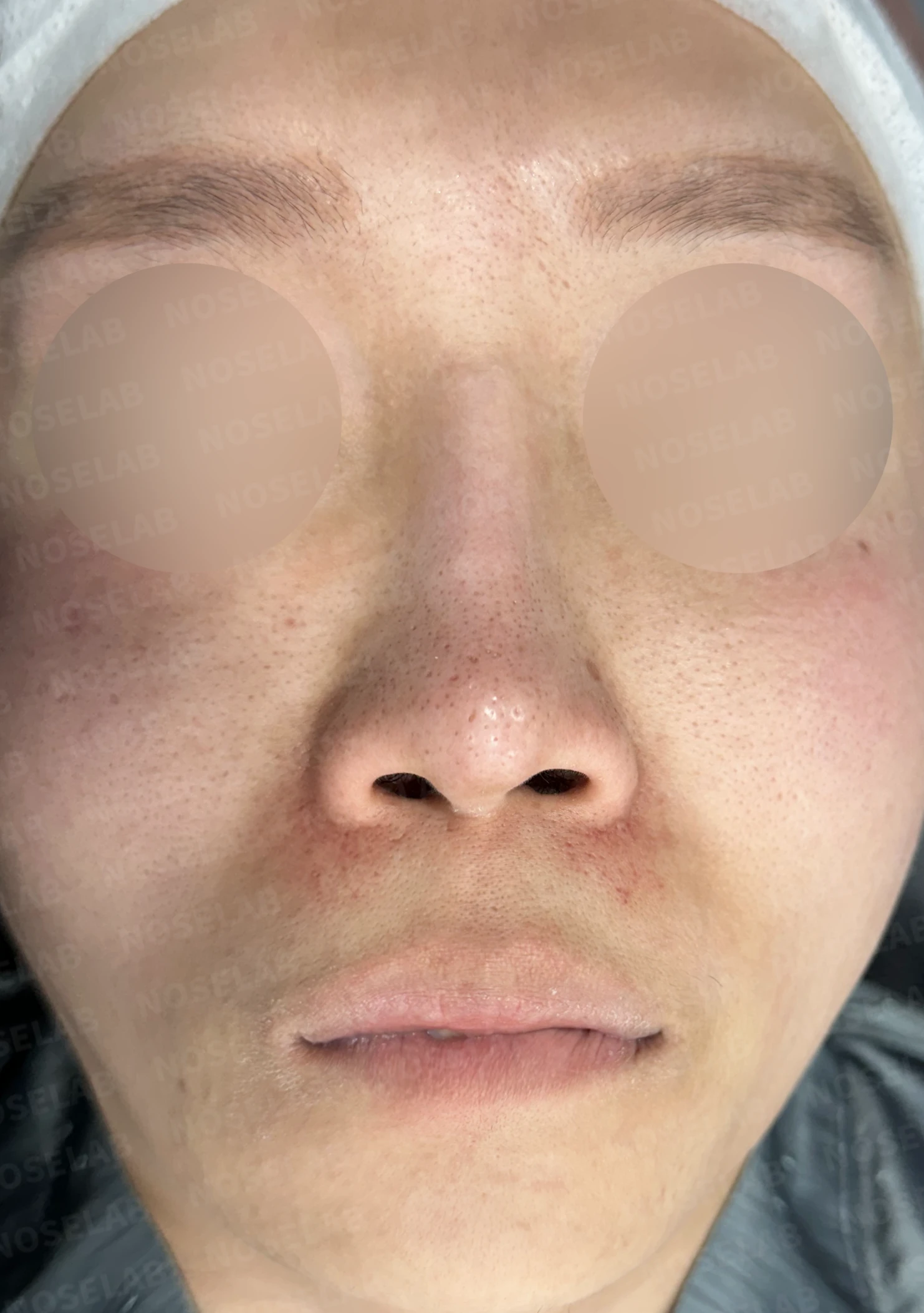 2차 코재수술, 자가늑연골로 비중격 재건과 직선 코 라인 완성 — 전(좌) 직후(후)