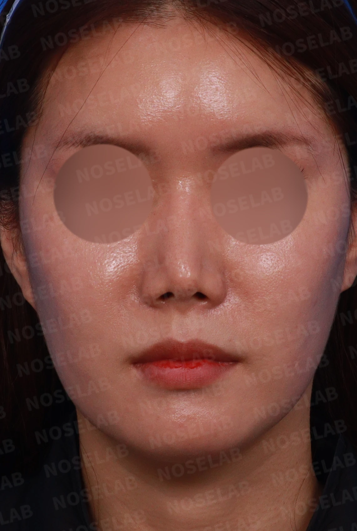 기증 늑연골이 흡수되면 코가 어떻게 변하고, 자가 늑연골 재건은 어떻게 하나 — 디자인 상담 정면 , 비스듬한 측면 사진, 좌측 측면