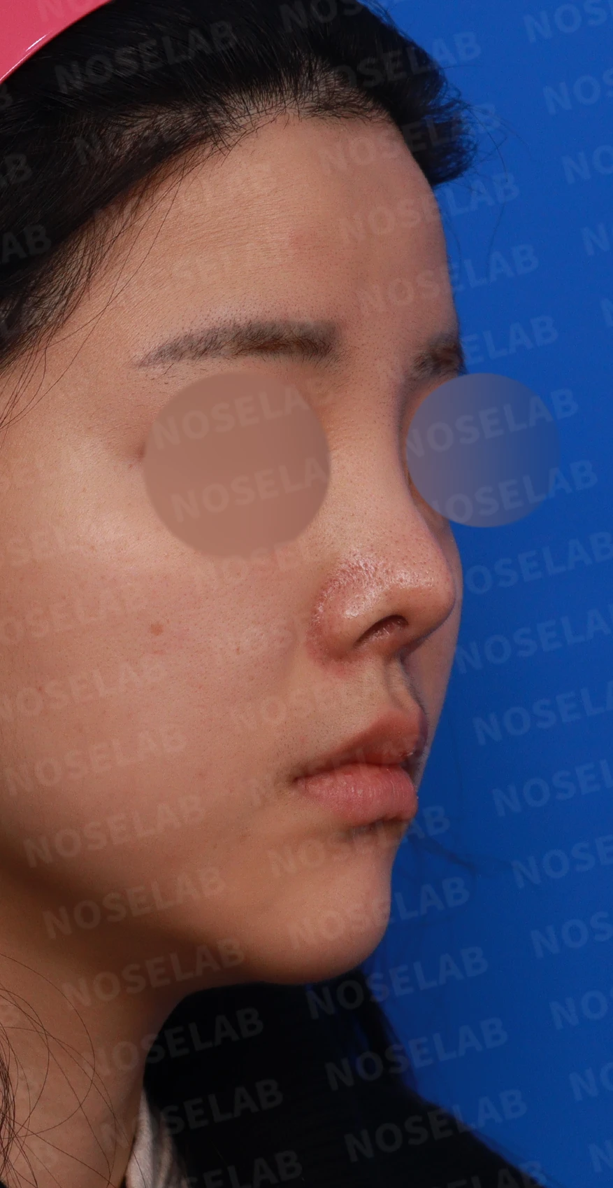 퍼진 콧대와 들린 코끝은 왜 생기나, 늑연골 재건은 어떻게 하나 — 디자인 상담 우측 비스듬한 측면, 측면, 비공 사진입니다.
