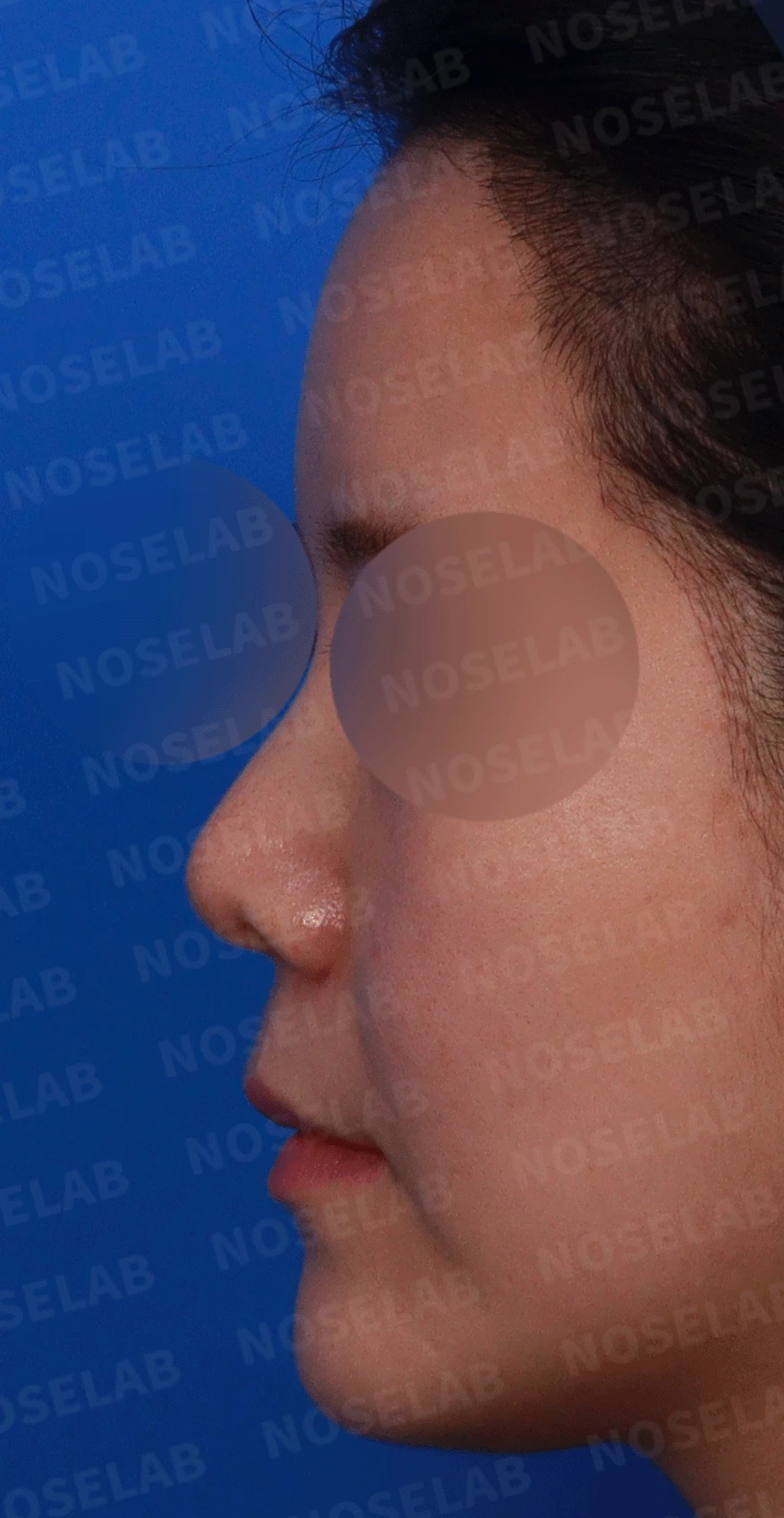 늑연골 석회화를 미리 확인해야 하는 이유와 휜코·짧은코 교정 방법 — 디자인 상담 정면 , 좌측 측면 , 비스듬한 측면 사진