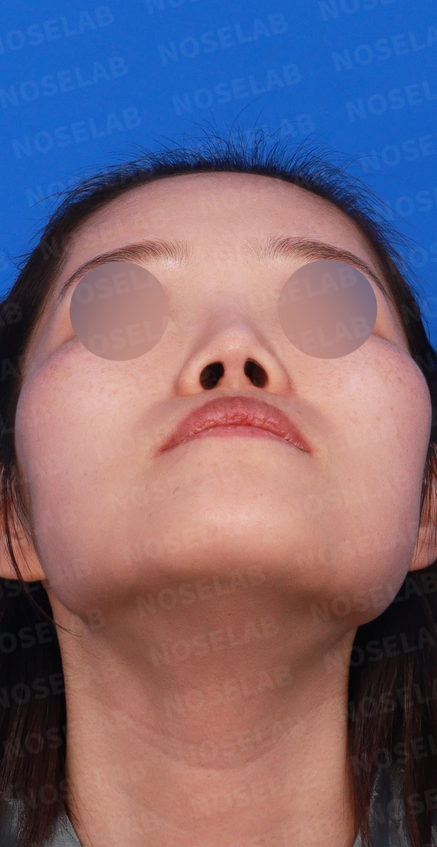 짧고 들린 코와 휜 코가 함께 생기는 이유, 비중격 연장 교정은 어떻게 하나 — 디자인 상담 우측 측면, 비스듬한 측면, 비공 사진입니다.