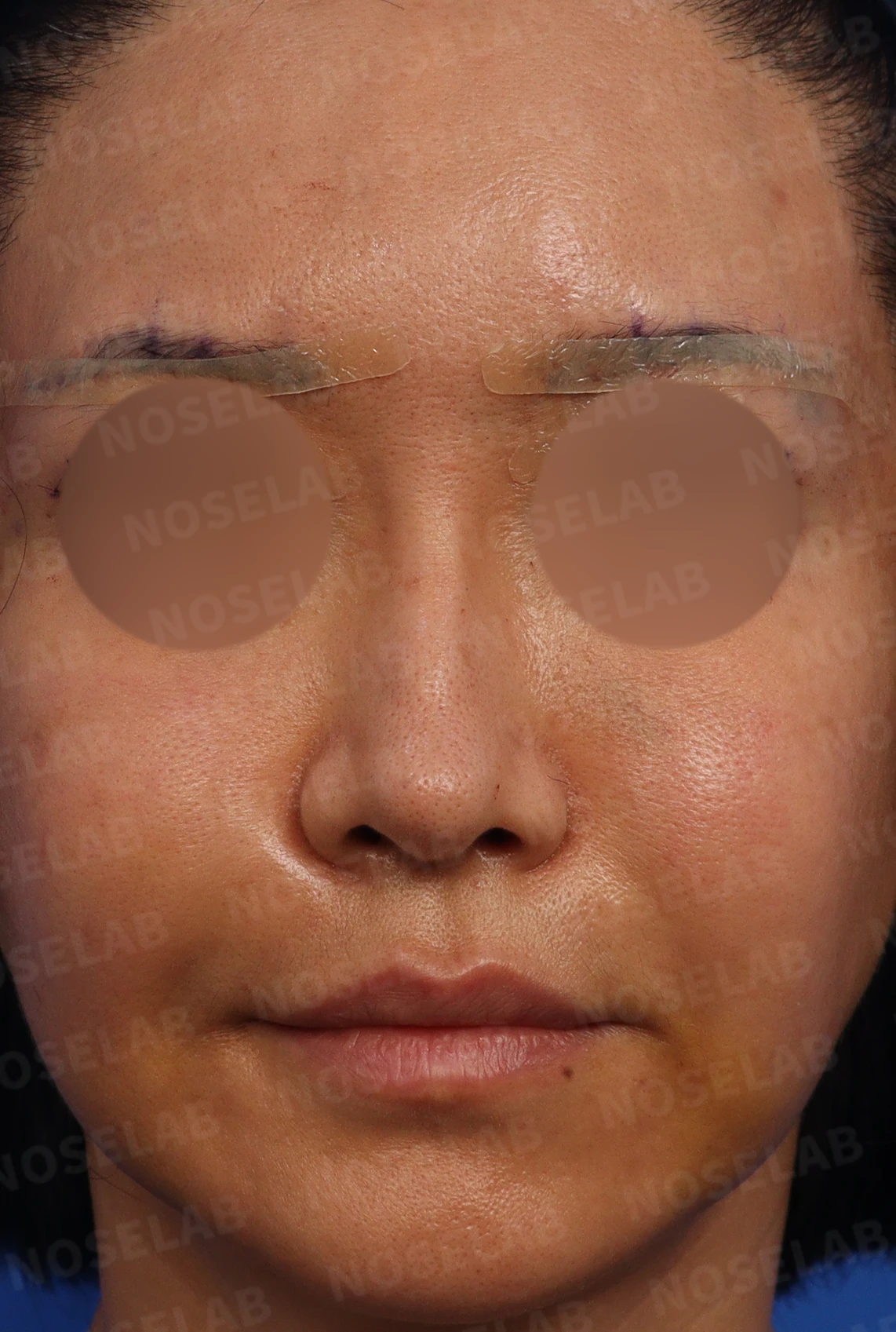 코의 높이와 입체감을 고려한 수술 계획 — 수술전 정면, 90도, 45도 사진입니다