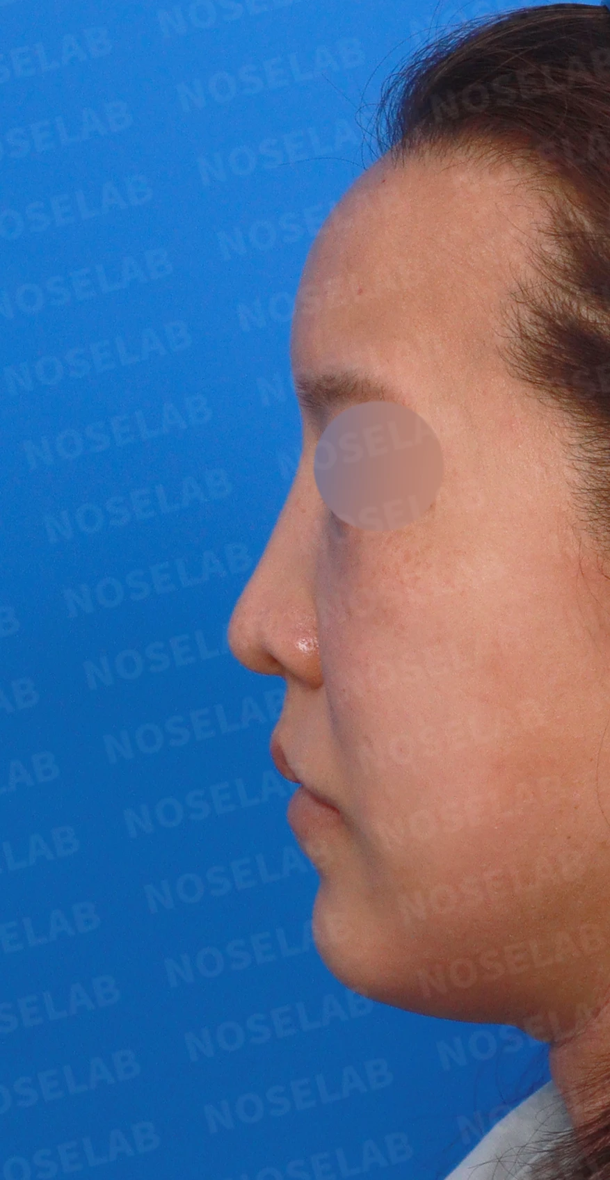 휜 코 교정과 코막힘 개선, 두 마리 토끼를 잡은 성공 사례 — 디자인 상담 정면, 좌측 측면, 비스듬한 측면 사진입니다.