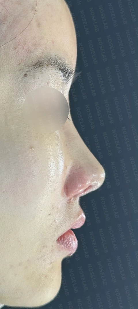 휜코, 뭉툭하고 처진코 수술 사례_대표원장 강차영 — 수술직후 사진 정면, 측면, 비스듬한 측면