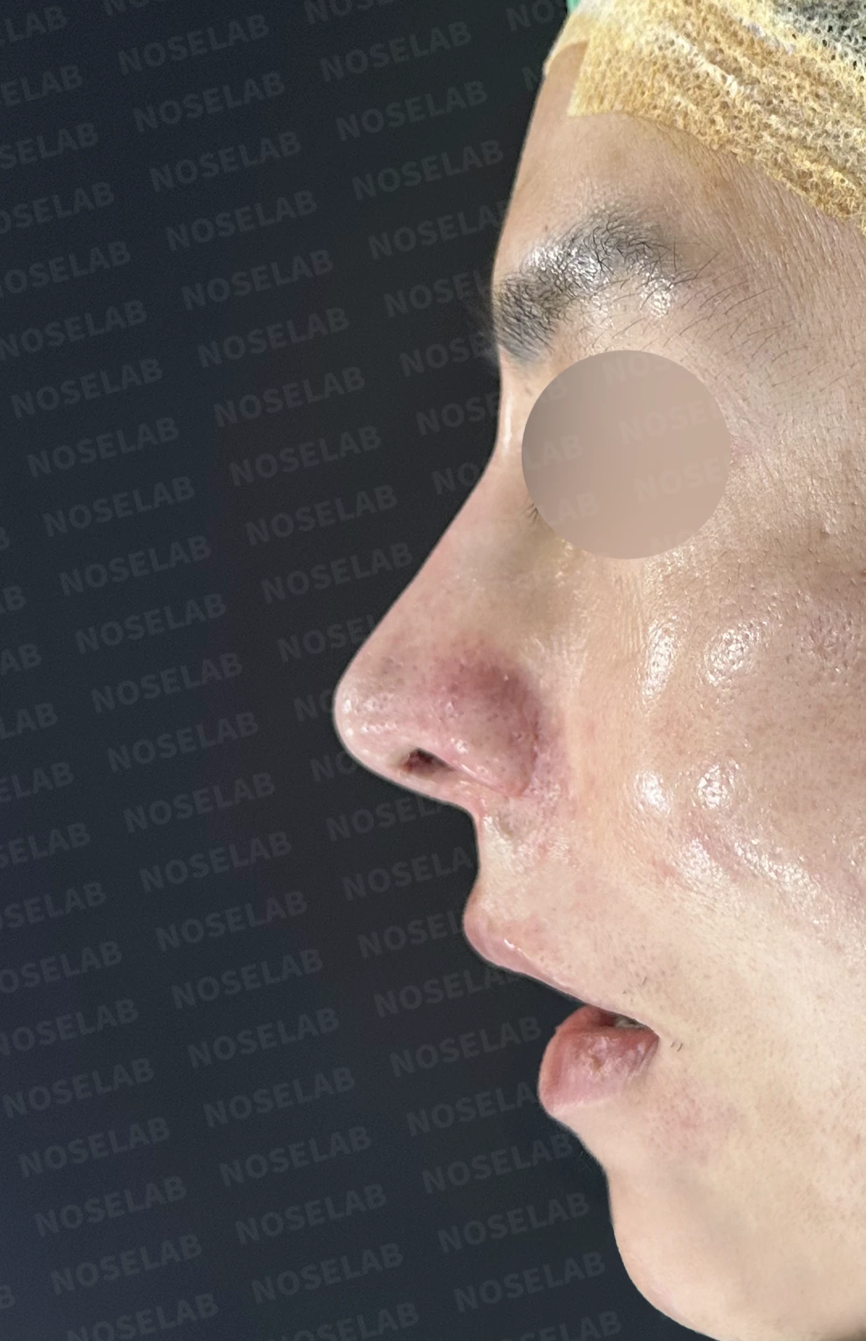 코재수술과 코막힘 교정, 기능과 심미 모두 잡은 비개방 코성형 사례 — 전(좌) 직후(후)