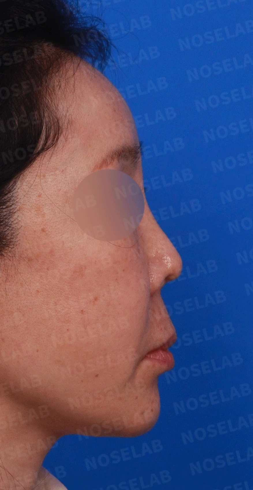 코가 짧고 들리며 비주가 함몰되는 이유, 자가 늑연골 재건은 어떻게 하나 — 본문 사진 5