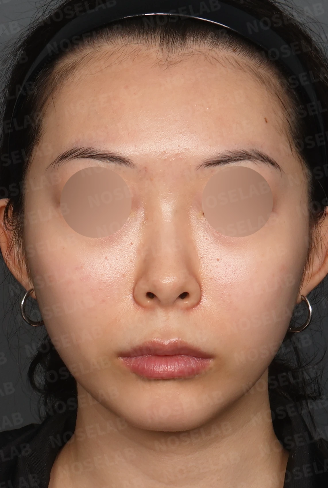 작고 낮은 코, 자가늑연골로 비순각 교정까지 한 번에 완성한 비개방 코성형 — 디자인 상담 정면, 좌측 측면, 비스듬한 측면 사진입니다.