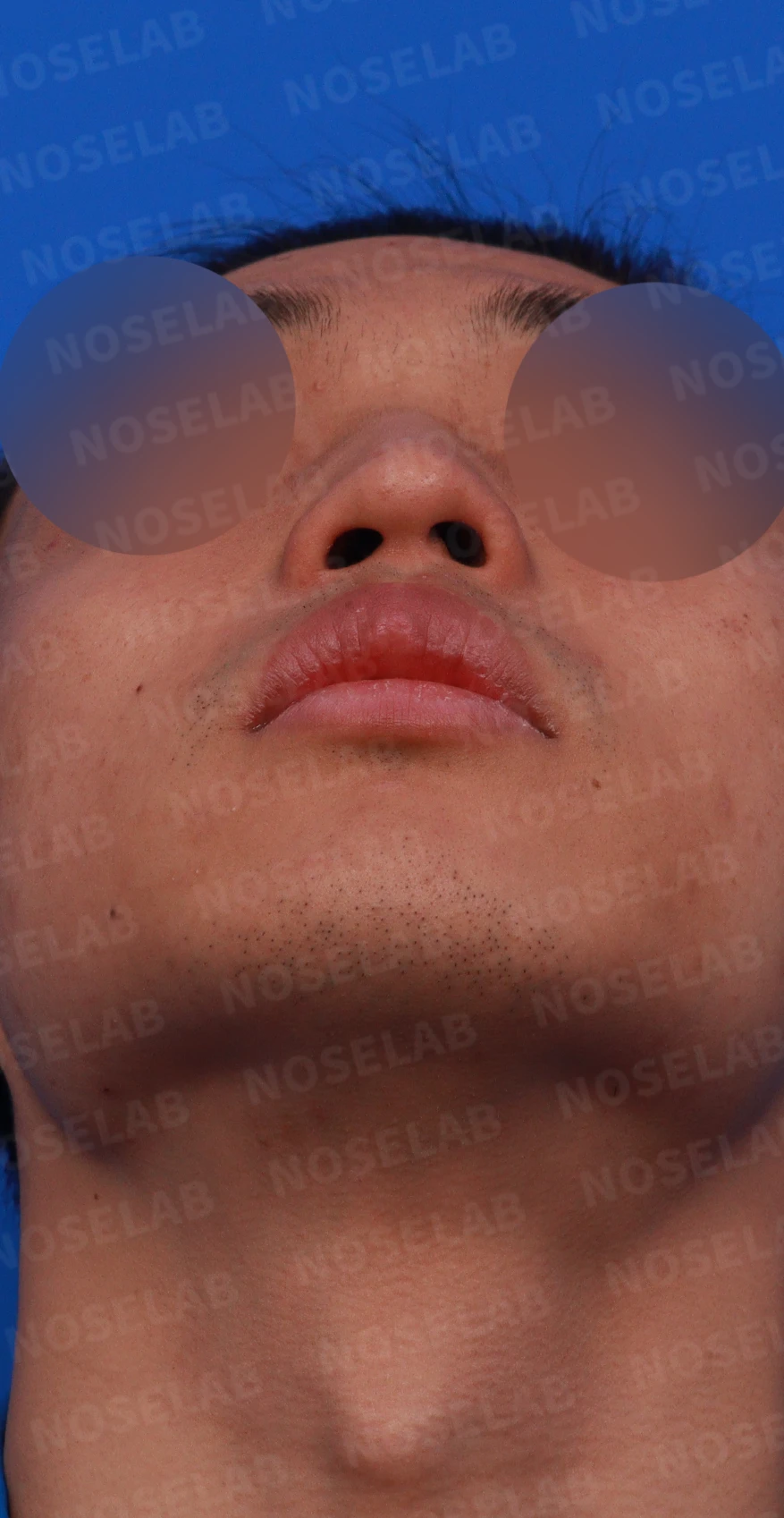 비염 수술 뒤에도 증상이 재발하는 이유, 휜 코를 함께 교정하는 방법 — 디자인 상담 우측 비스듬한 측면, 측면, 비공 사진