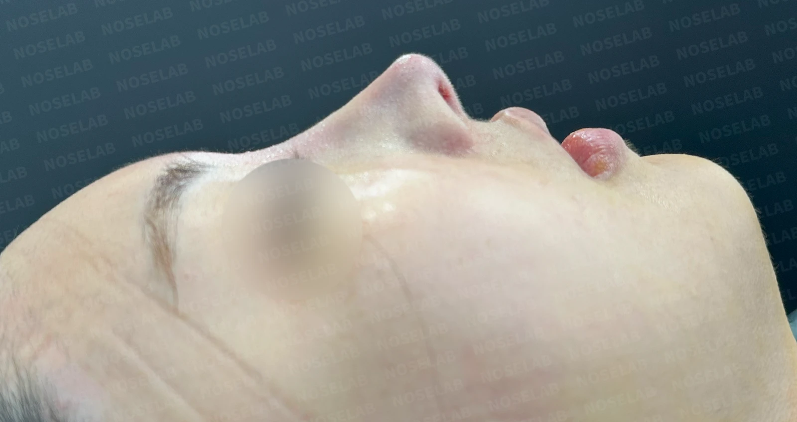 퍼진 코 개선과 콧구멍 비대칭 교정 방법 — 본문 사진 14