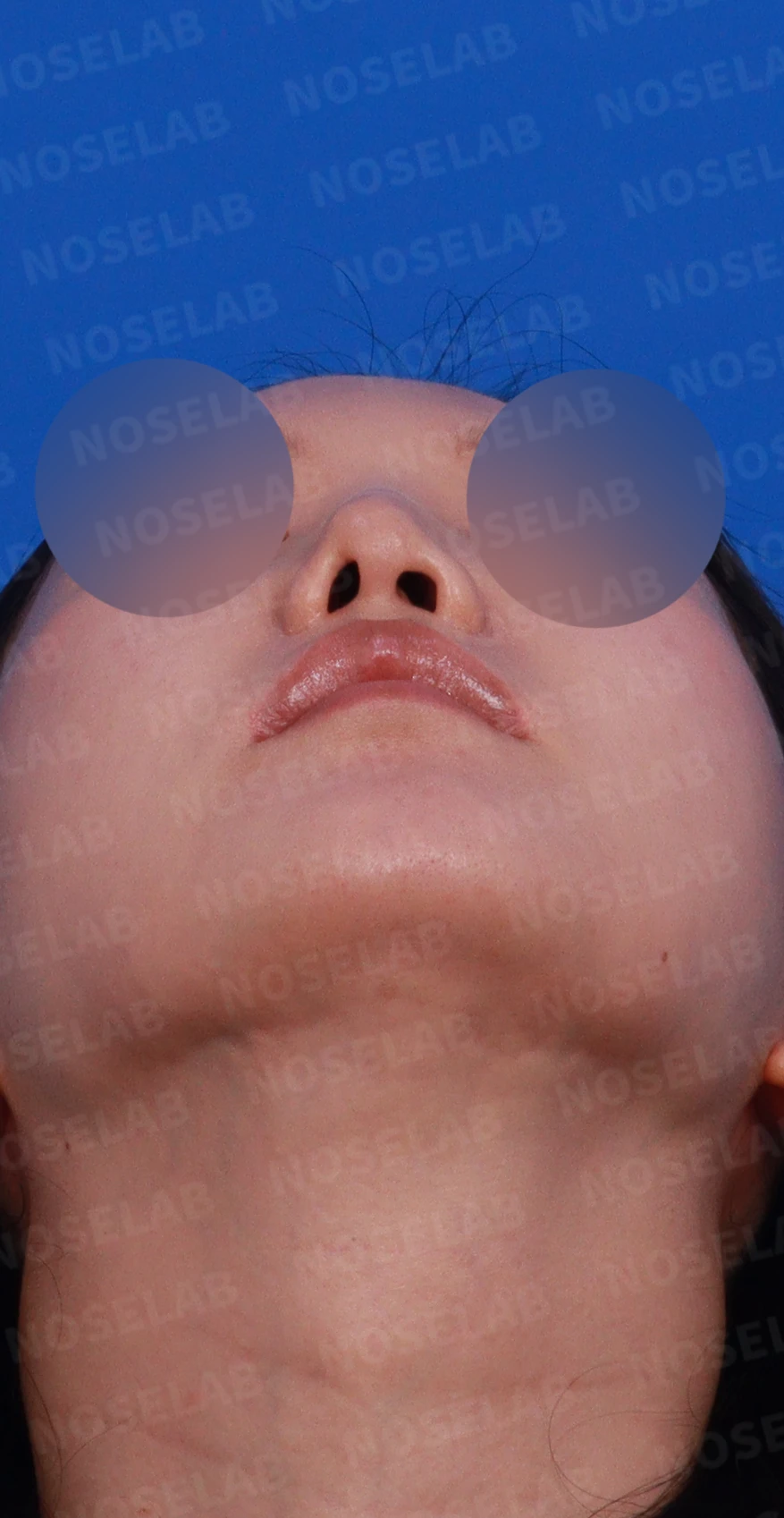 비공 비대칭과 코끝 처짐은 왜 생기나, 연골을 병용한 재건 방법 — 디자인 상담 우측 측면, 비스듬한 측면, 비공 사진