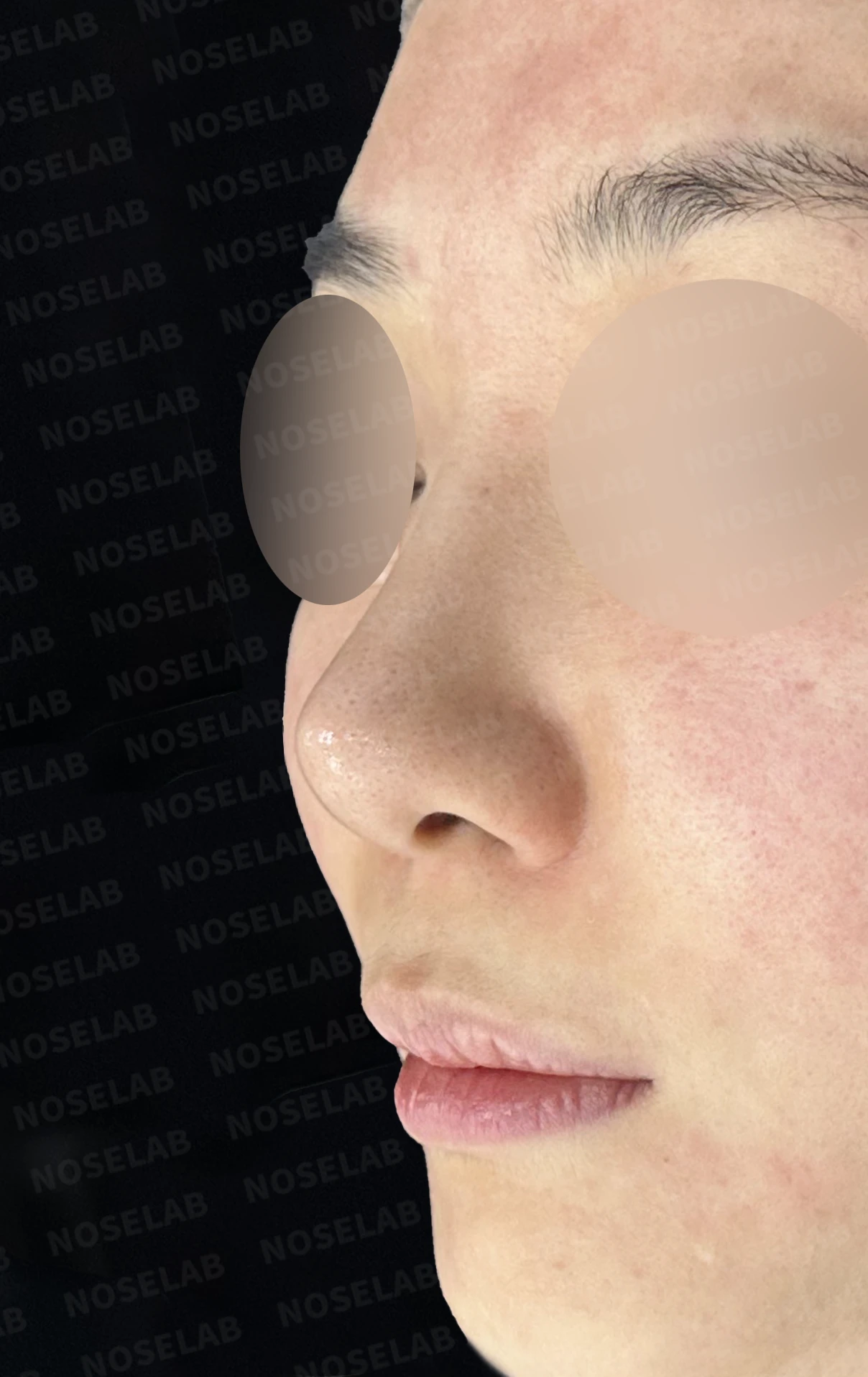 L자 보형물 제거 후 자가 늑연골로 코끝을 교정한 코재수술 — 전(좌) 직후(후)