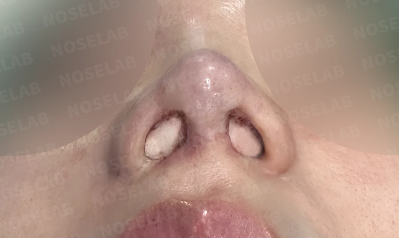 들린코와 비공 비대칭, 기증늑연골로 정교하게 교정한 코재수술 — 직후 비공 사진입니다.