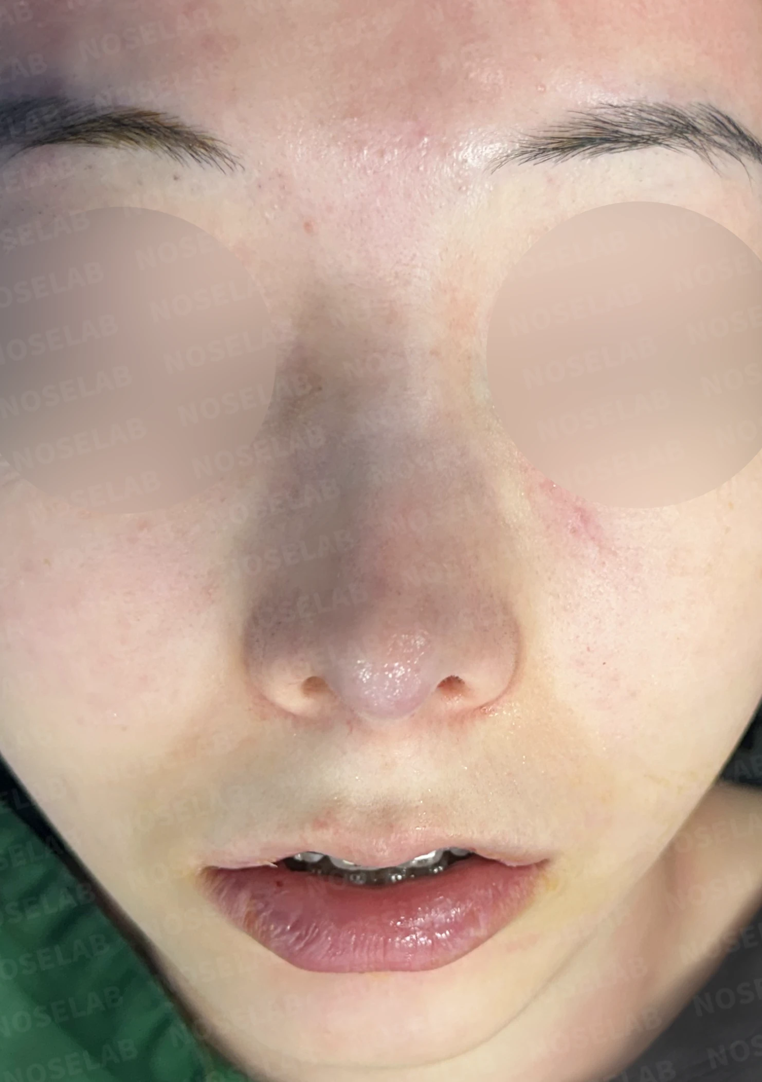 작고 낮은 코, 자가늑연골로 비순각 교정까지 한 번에 완성한 비개방 코성형 — 직후 정면, 비스듬한 측면, 측면 사진입니다.