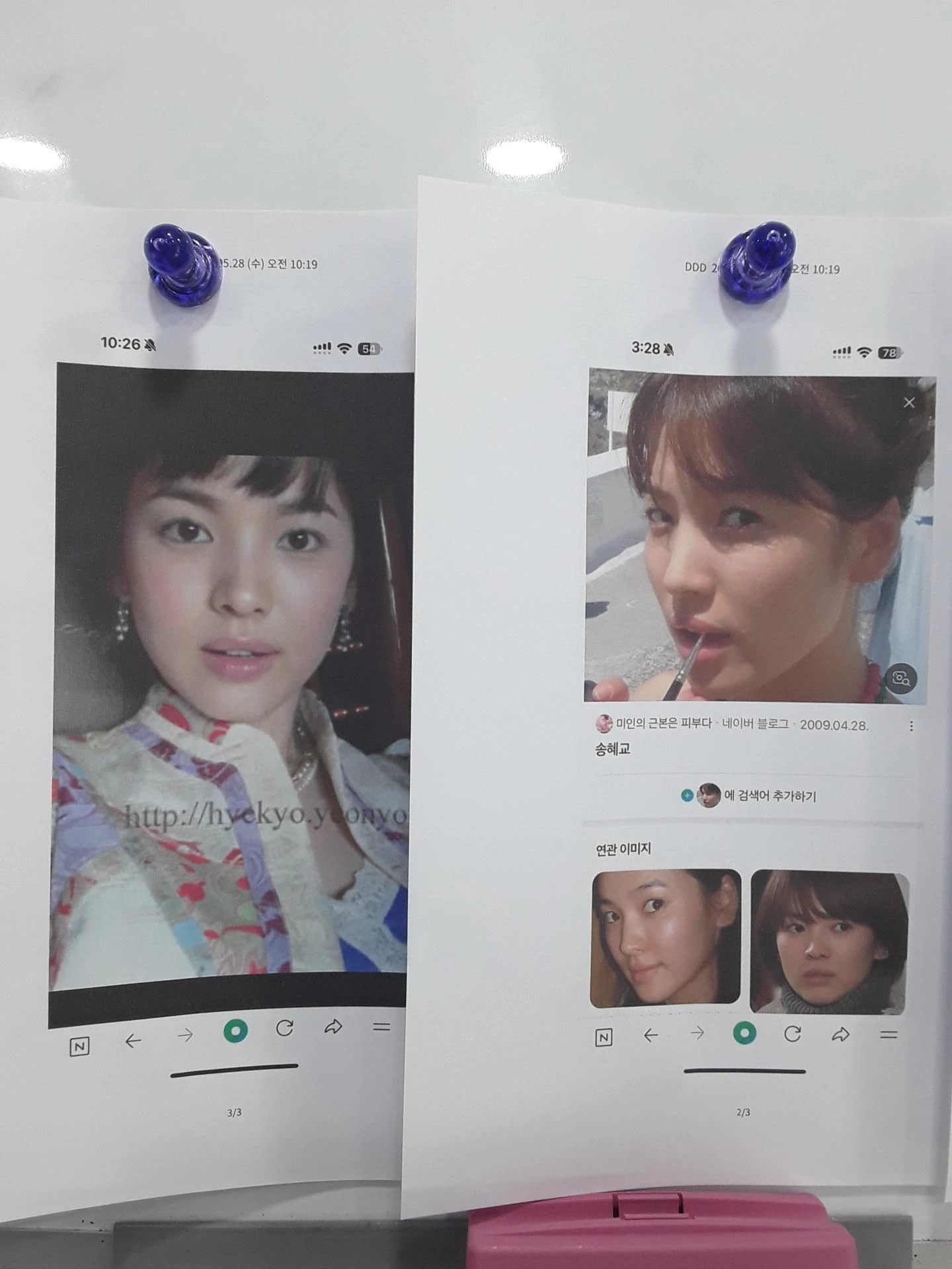 14년간 7차례 수술 후 비중격천공과 복잡한 코끝 문제 해결 - 자가늑연골 재건 실제 후기 — 환자분의 원하는 이미지
