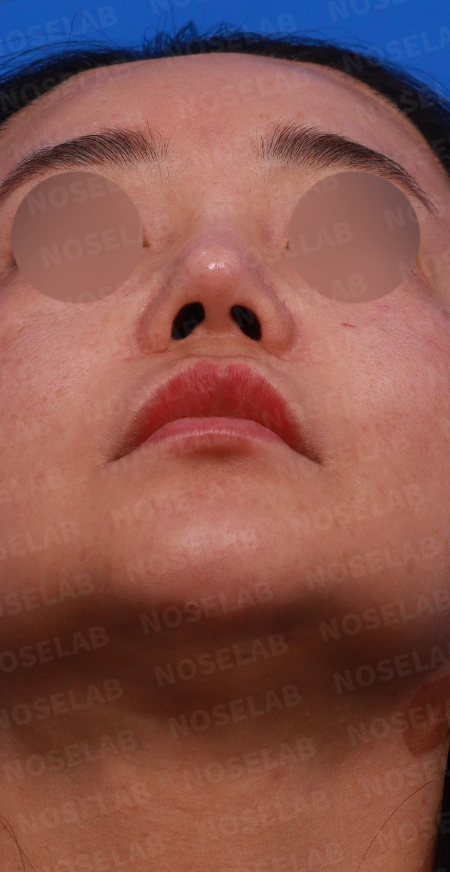 코재수술에서 비중격을 재건하는 방법 — 디자인 상담 비공, 우측 측면, 비스듬한 측면 사진