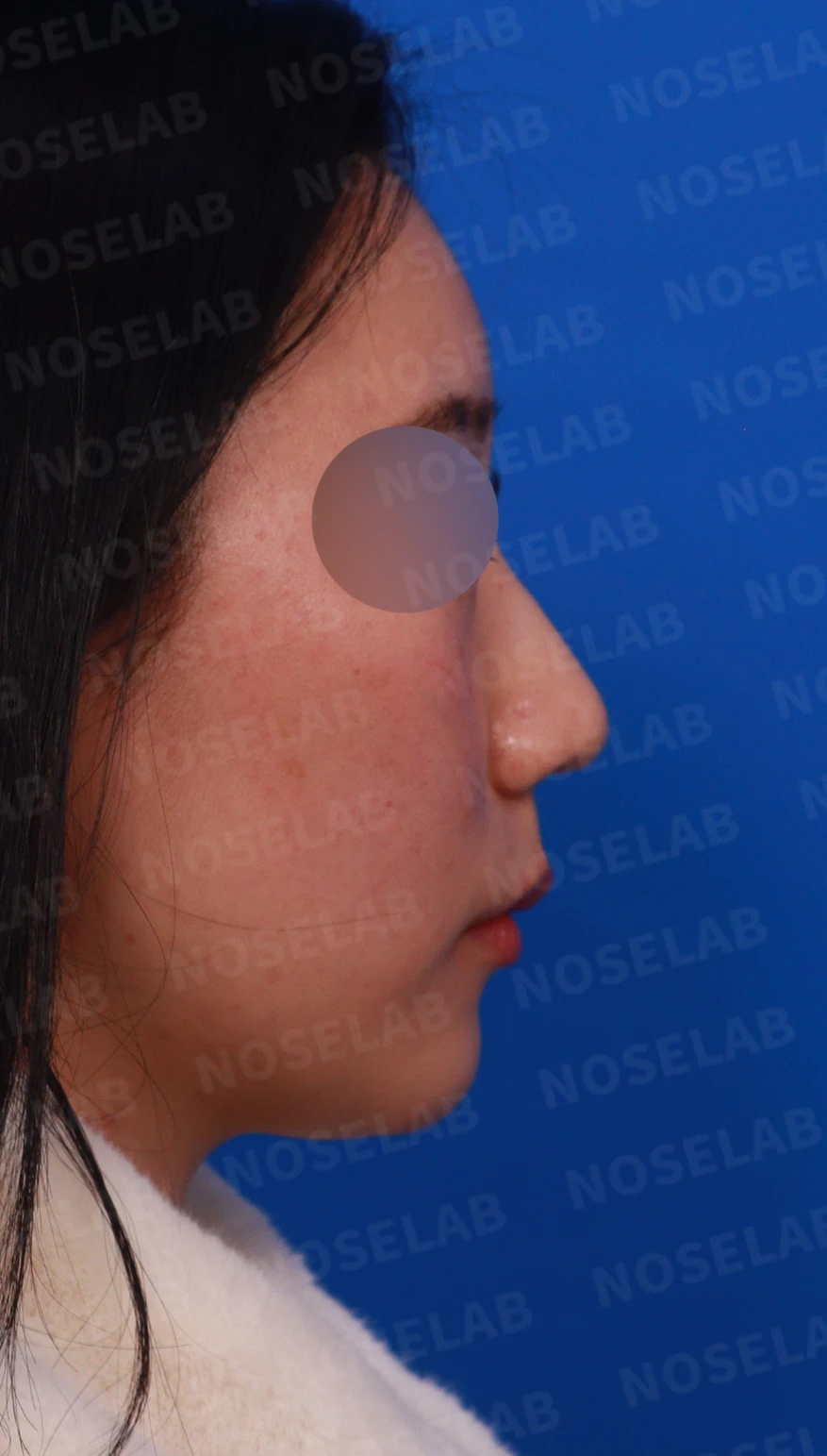 코뼈 비대칭과 처진 코끝에 만성 비염이 겹칠 때 보는 것 — 디자인 상담 정면, 우측 측면, 비스듬한 측면 사진