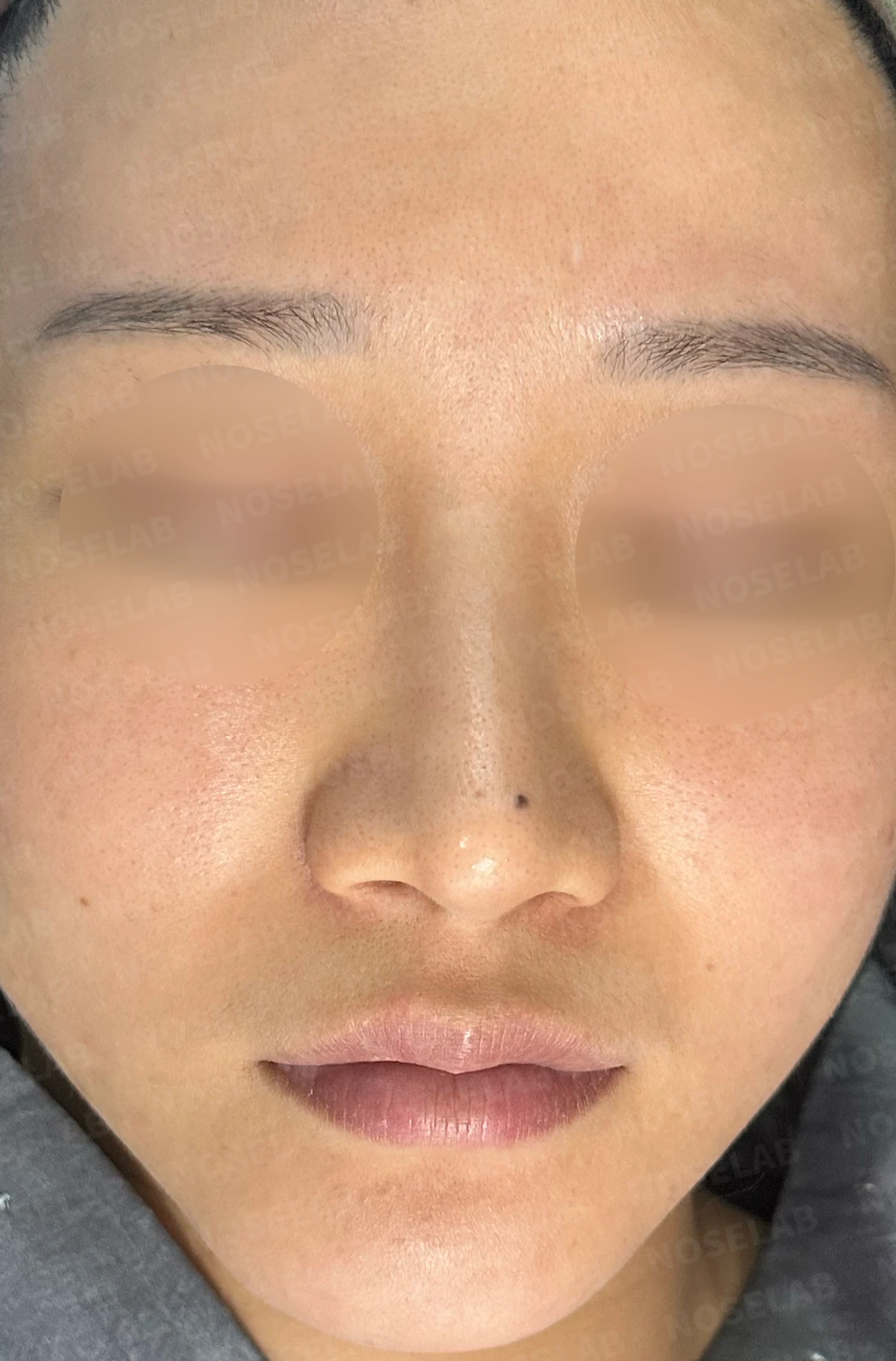 비공 비대칭, 퍼진코! 코재수술 사례 — 전(좌) 직후(우)