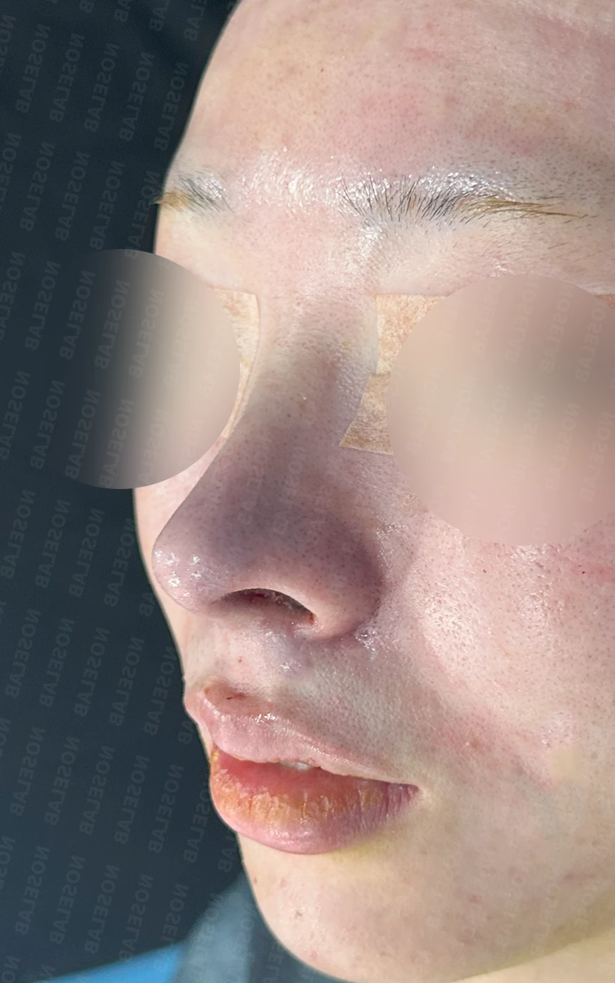 퍼진코, 복코 교정으로 균형 잡힌 이미지 완성 — 전(좌) 직후(우)