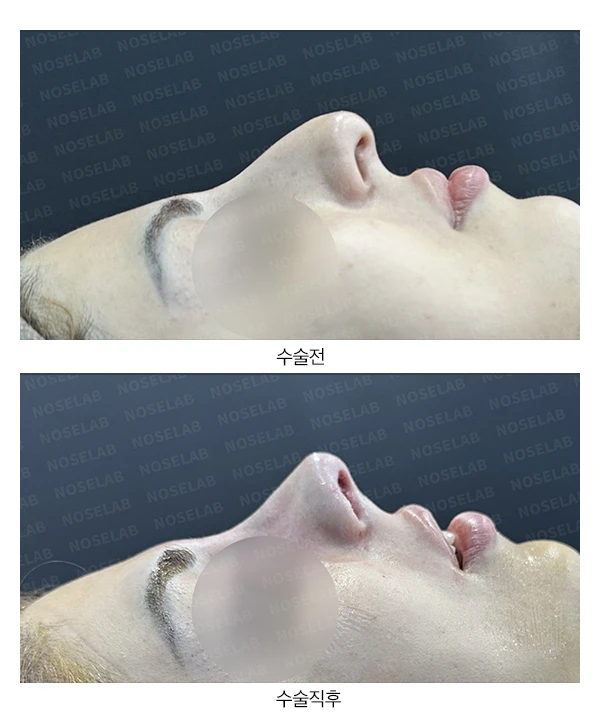 매부리코, 휜코 교정 방법 — 전후 비교