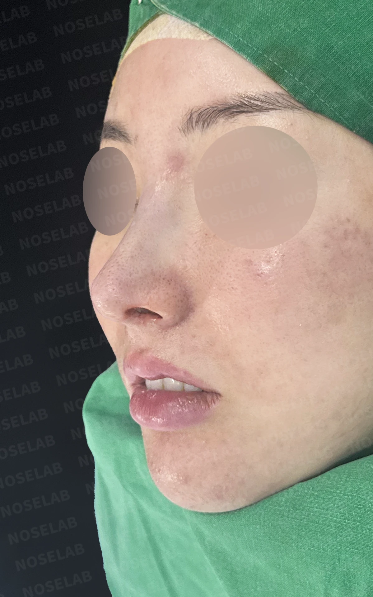 코가 길어 보이고 비주가 휘는 이유, 비중격 연장과 재건은 어떻게 하나 — 수술 직후 0일 정면, 비스듬한 측면, 측면 사진 직후 사진은 부기가 있는 상태로 최종 결과와 다를 수 있습니다.