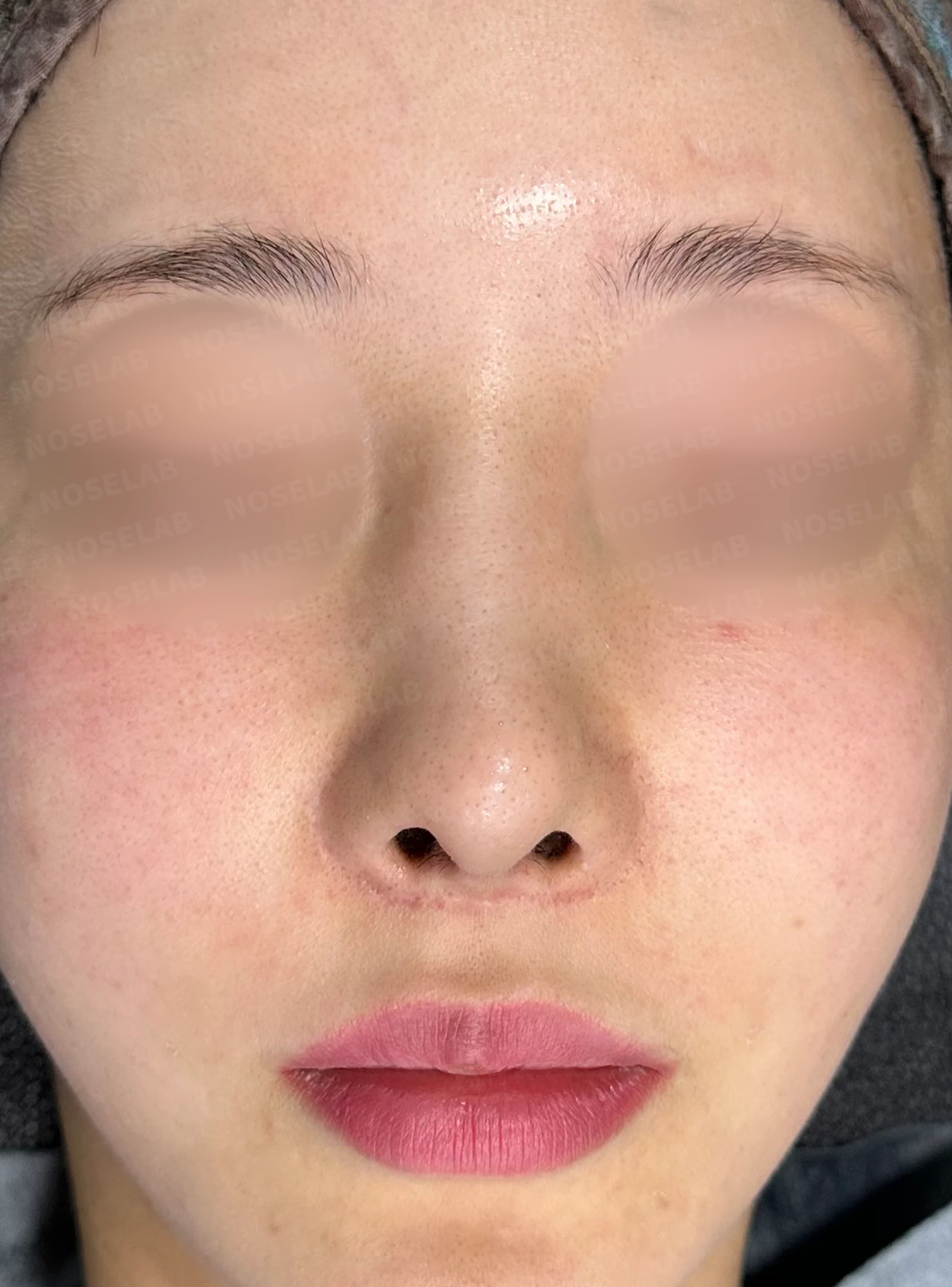 수술 후 14일 조기 교정에서 확인할 점 — 수술 전 / 수술 직후 0일 직후 사진은 부기가 있는 상태로 최종 결과와 다를 수 있습니다.