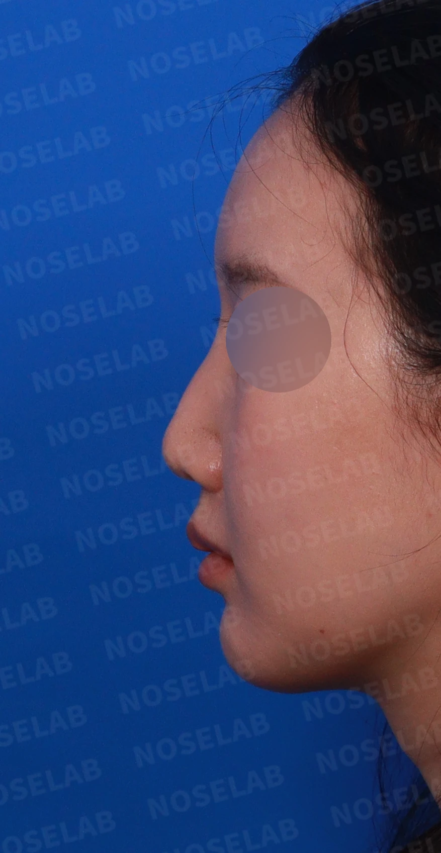 비공 비대칭과 코끝 처짐은 왜 생기나, 연골을 병용한 재건 방법 — 디자인 상담 정면, 좌측 측면, 비스듬한 측면 사진