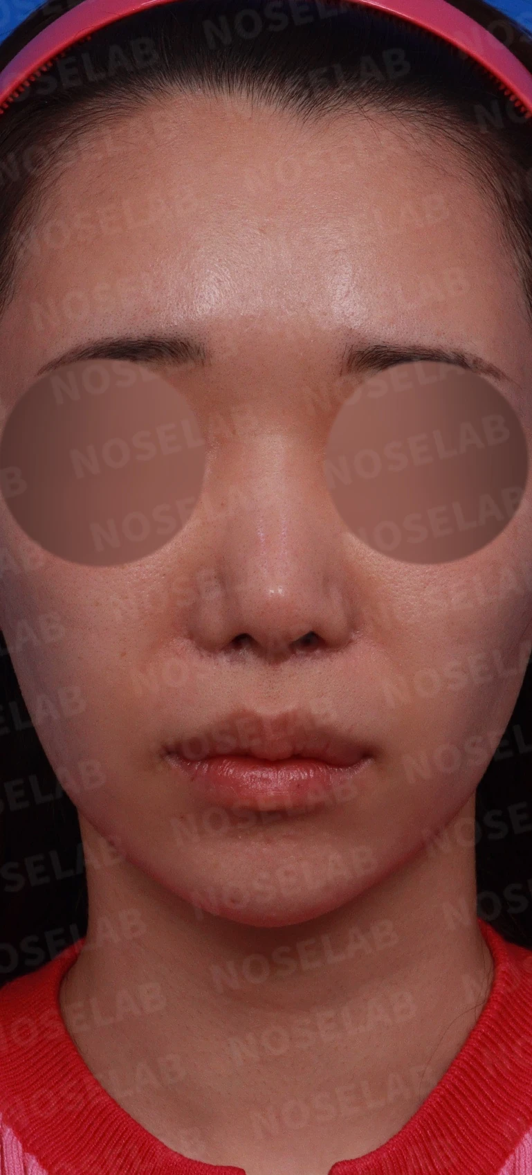 콧구멍 비대칭과 협착이 생기는 이유, 늑연골 재건과 Z성형은 어떻게 하나 — 디자인 상담 정면, 좌측 비스듬한 측면, 측면 사진입니다.
