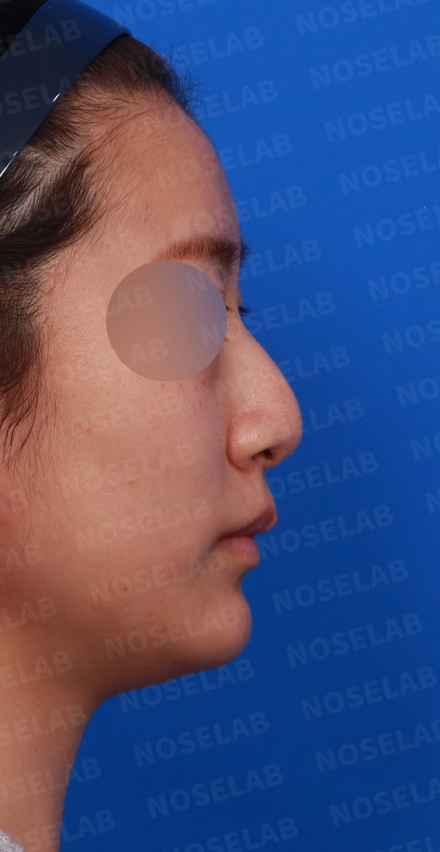 복코와 퍼진 코, 처진 코끝이 함께 오는 이유와 슬림한 라인을 만드는 방법 — 디자인 상담 우측 비스듬한 측면, 측면, 비공 사진
