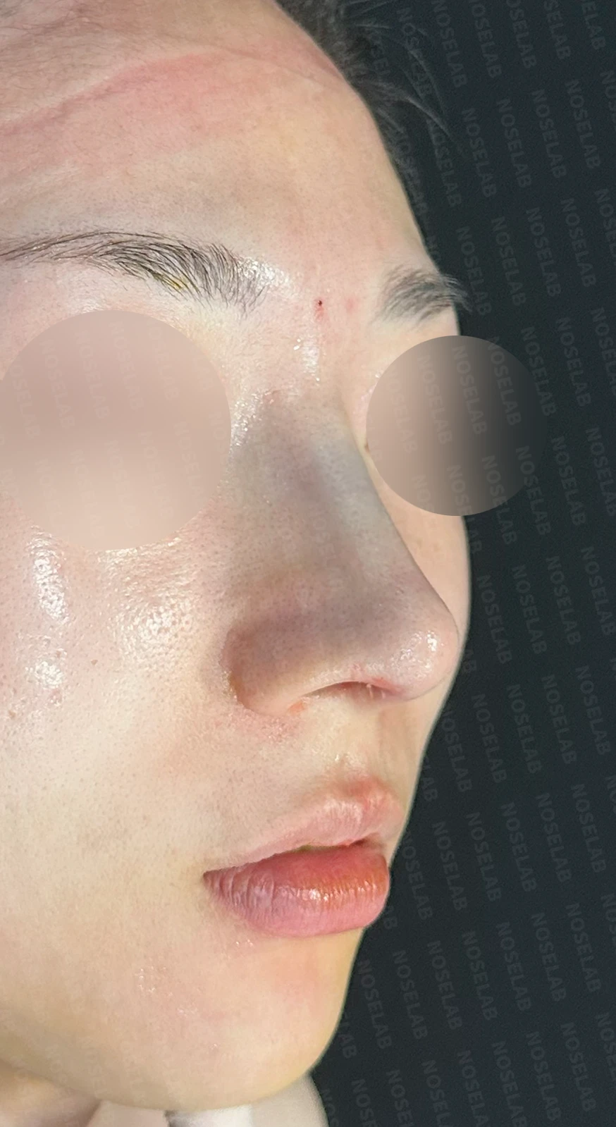 퍼진 코와 복코를 함께 교정하는 방법 — 수술 직후 0일 정면, 측면, 비스듬한 측면사진입니다. 직후 사진은 부기가 있는 상태로 최종 결과와 다를 수 있습니다.