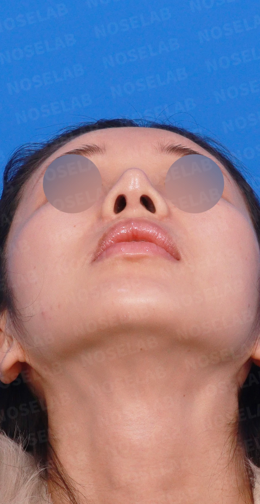 코끝 연골이 피부로 비쳐 보이는 이유와 진피 보강 방법 — 디자인 상담 우측 측면, 비스듬한 측면, 비공 사진입니다.
