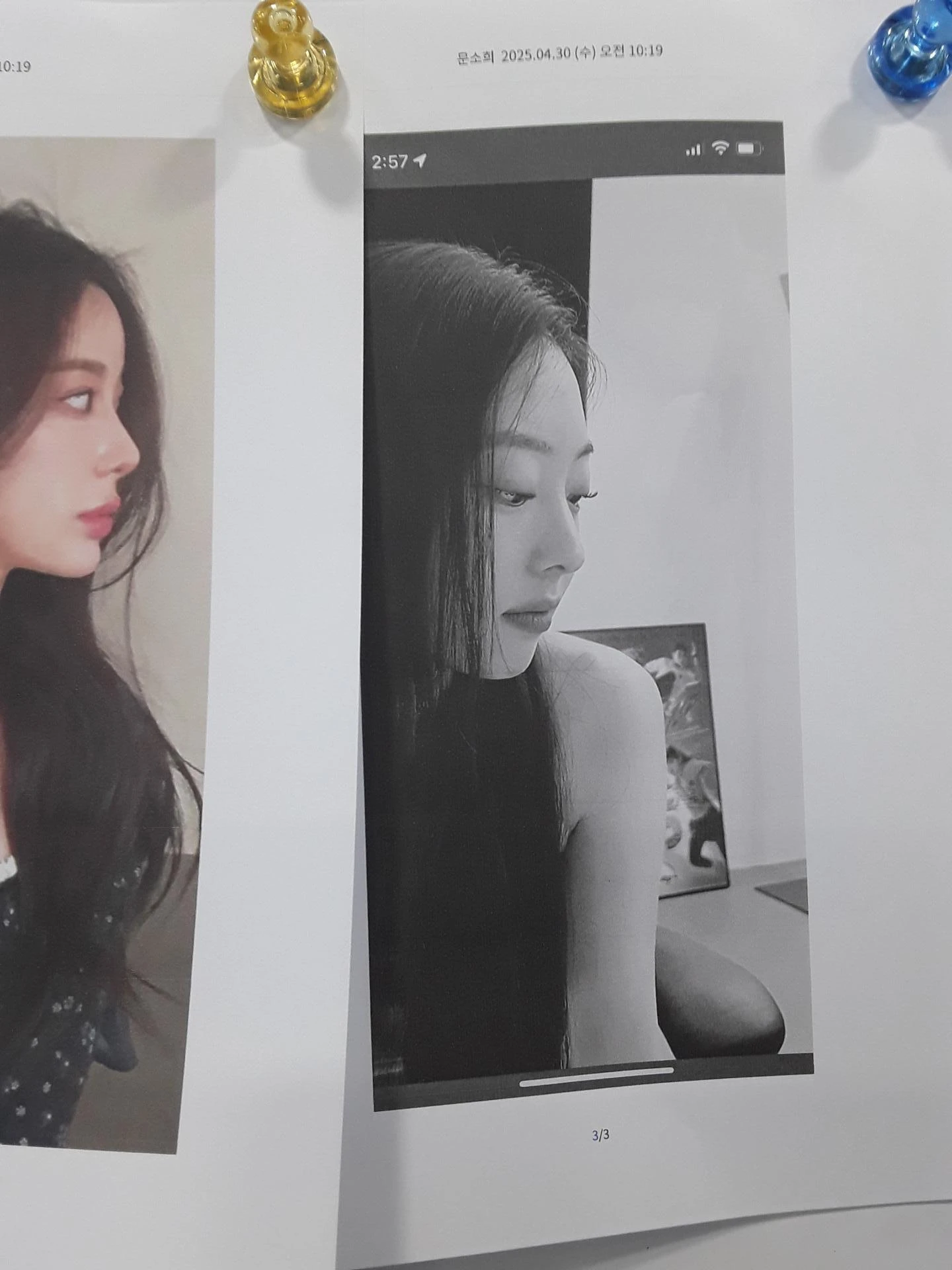 코끝이 비치는 이유와 코끝 포인트를 낮추는 교정 방법 — 환자분의 원하는 이미지