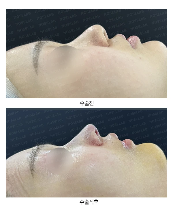 찝혀 올라간 콧구멍 교정 방법 — 전후 비교
