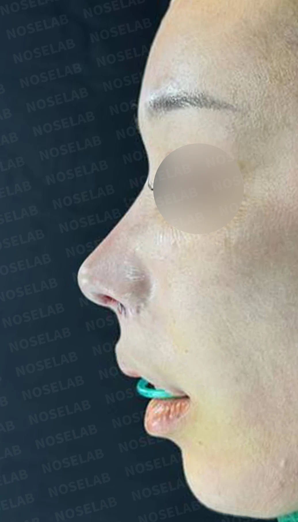 콧구멍 비대칭과 협착이 생기는 이유, 늑연골 재건과 Z성형은 어떻게 하나 — 수술 전 / 수술 직후 0일 직후 사진은 부기가 있는 상태로 최종 결과와 다를 수 있습니다.