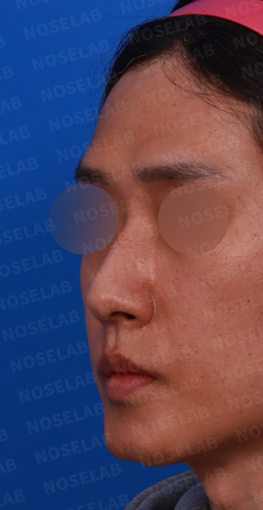 안면 비대칭이 있는 코에 맞춤형 보형물을 쓰는 이유와 매부리 교정 방법 — 디자인 상담 정면, 비스듬한 측면,좌측 측면 사진입니다.
