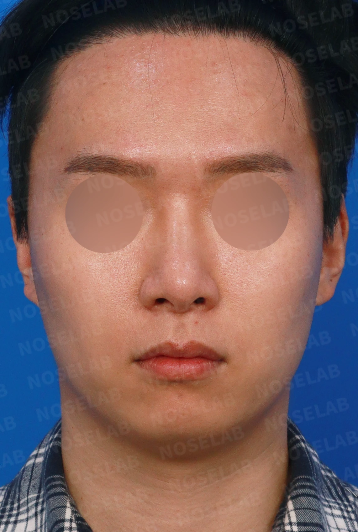 한쪽 비골이 함몰되면 왜 코가 휘어 보이는가, 절골 복원과 비중격 재건 — 디자인 상담 정면, 좌측 측면, 비스듬한 측면 사진