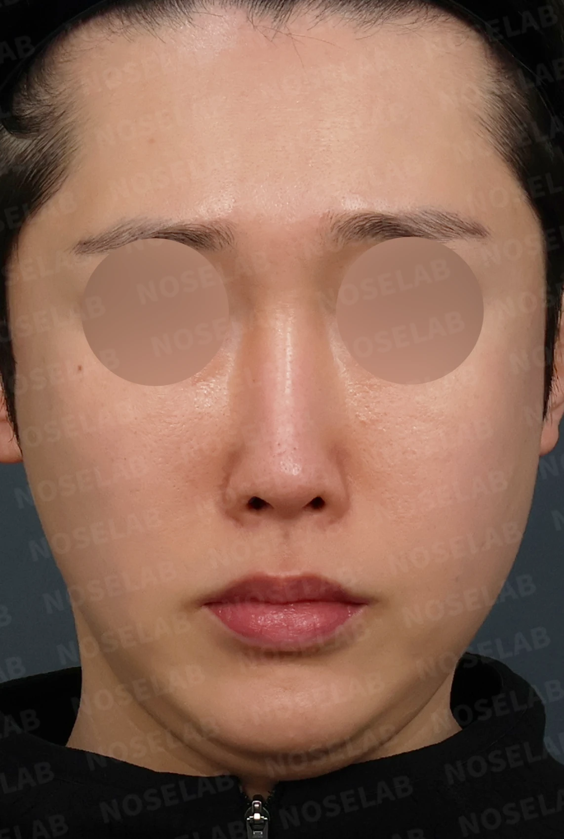 실리콘이 휘고 코가 길어 보이는 이유, 보형물 교체와 늑연골 재건은 어떻게 하나 — 디자인 상담 정면, 좌측 측면, 비스듬한 측면 사진입니다.