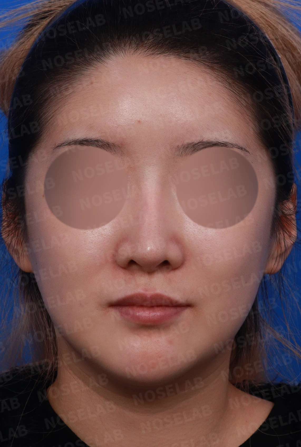 코재수술 뒤 콧대가 붉어 보이는 이유와 재건 방법 — 디자인 상담 정면, 좌측 측면, 비스듬한 측면 사진