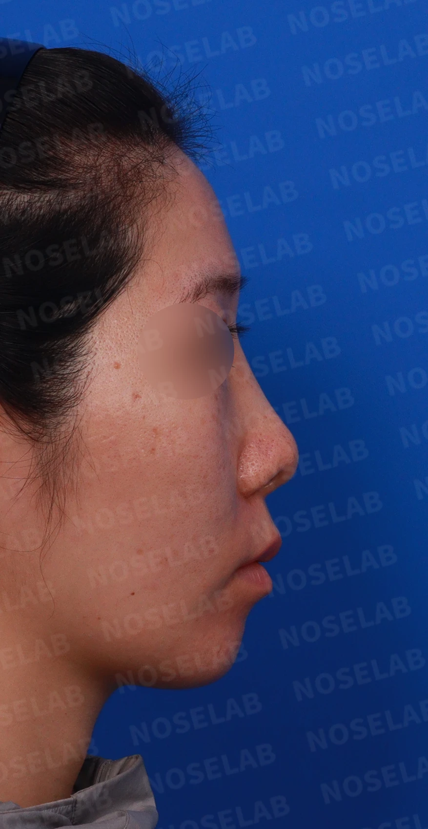 콧대 시작점이 높고 코가 휘어 보이는 이유, 자가 늑연골 교정은 어떻게 하나 — 디자인 상담 우측 측면 , 비스듬한 측면 , 비공 사진입니다.