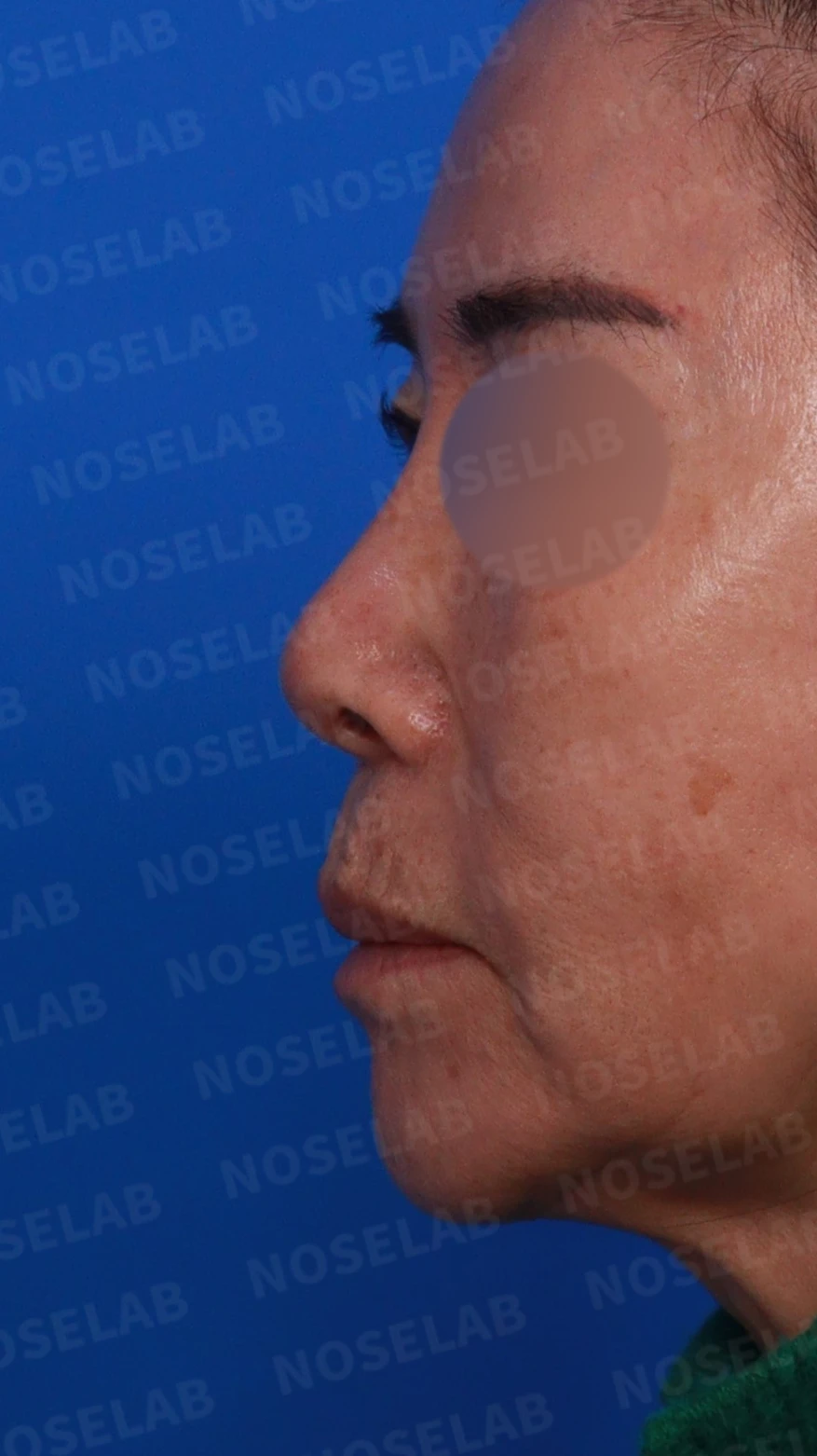 오래된 실리콘 보형물이 변형과 통증을 일으키는 이유, 늑연골 재건은 어떻게 하나 — 디자인 상담 정면, 좌측 측면, 비스듬한 측면 사진