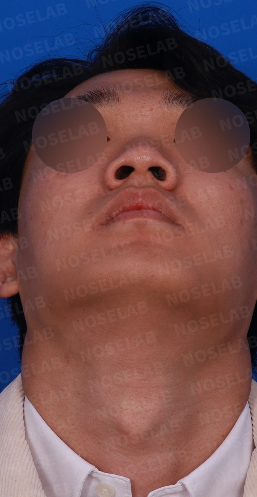 낮은 코와 코막힘을 함께 살펴보는 교정 방법 — 디자인 상담 우측 측면, 비스듬한 측면, 비공 사진