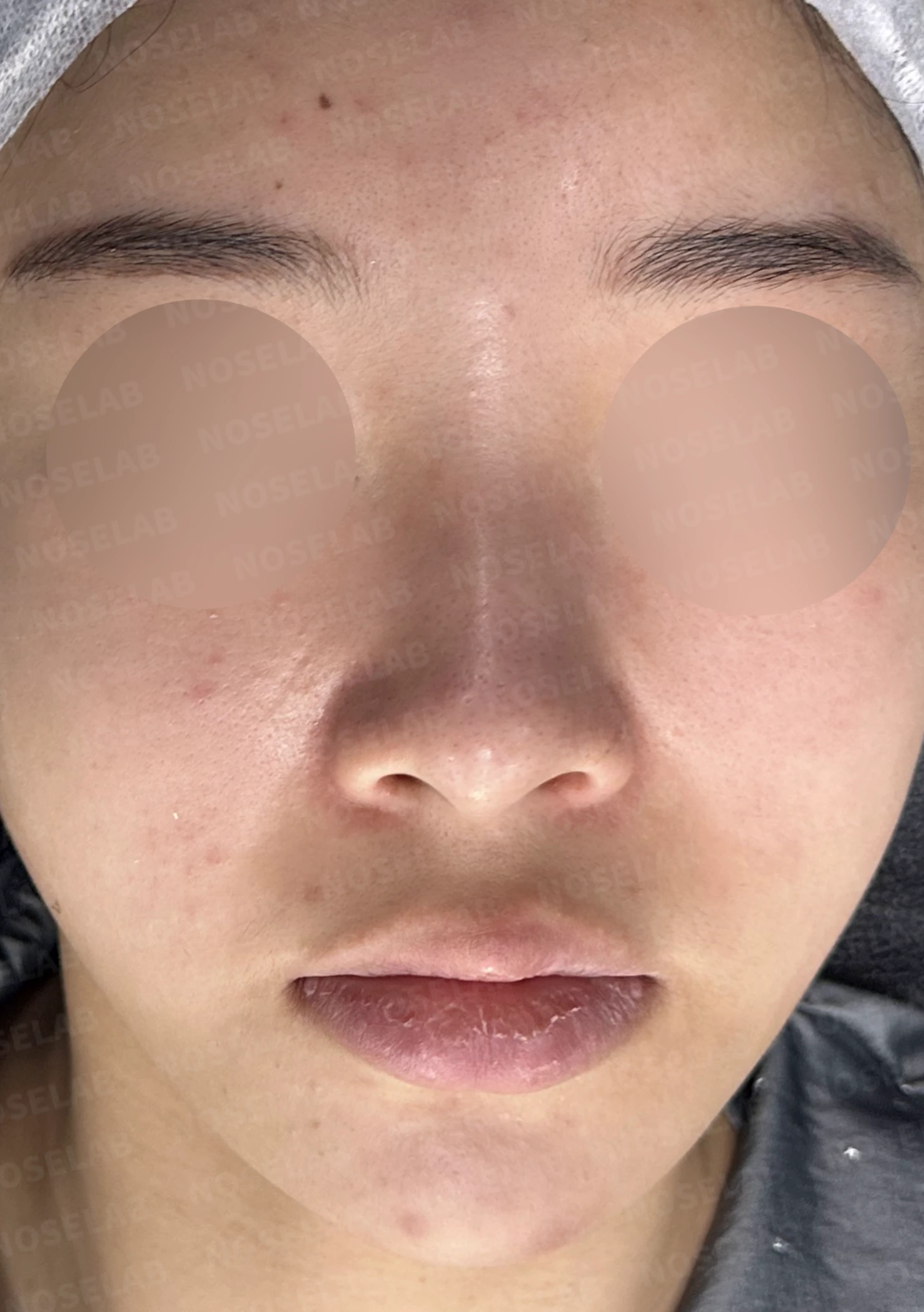 콧대가 넓고 단차져 보이는 이유, 절골술과 늑연골 코끝 성형은 어떻게 하나 — 수술 전 / 수술 직후 0일 직후 사진은 부기가 있는 상태로 최종 결과와 다를 수 있습니다.
