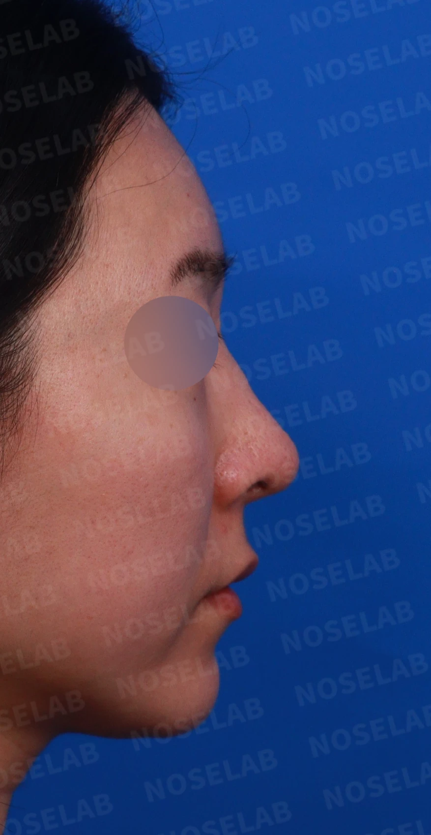 외측절골 후 코막힘과 비대칭을 살펴보는 교정 방법 — 디자인 상담 우측 측면, 비스듬한 측면, 비공 사진