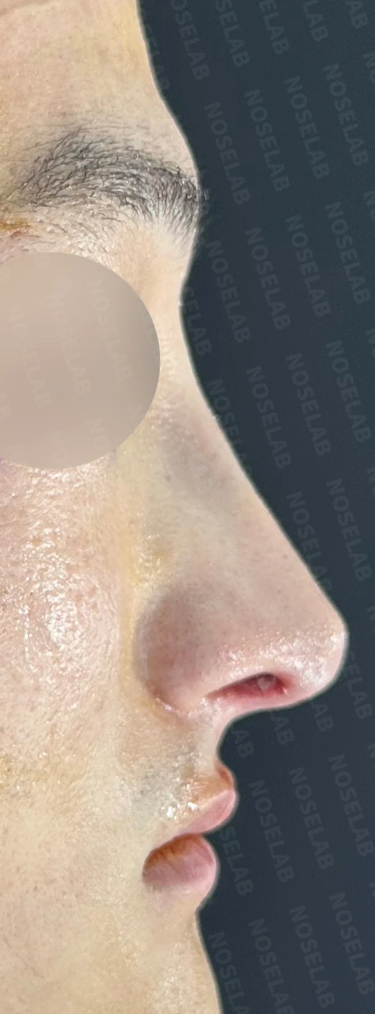 휜코 교정하면 안면 비대칭이 좋아질까요? — 수술 직후 0일 사진들입니다. 직후 사진은 부기가 있는 상태로 최종 결과와 다를 수 있습니다.