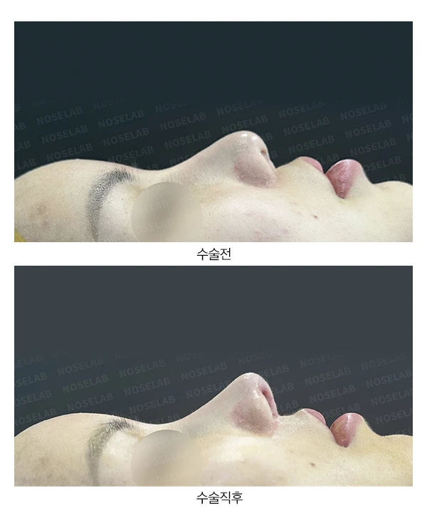 뭉툭하고 처진 코의 자가늑연골 재수술과 비주·비공 교정 방법 — 전후 비교