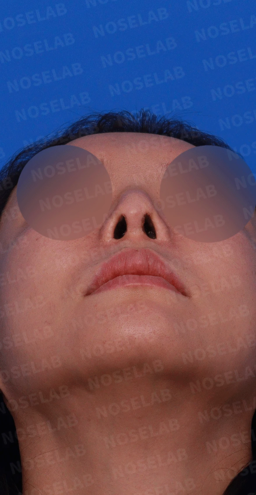인공진피 이식 후 코끝이 비쳐 보이는 이유와 자가 늑연골 재건 방법 — 디자인 상담 우측 측면 , 비스듬한 측면 , 비공 사진입니다.