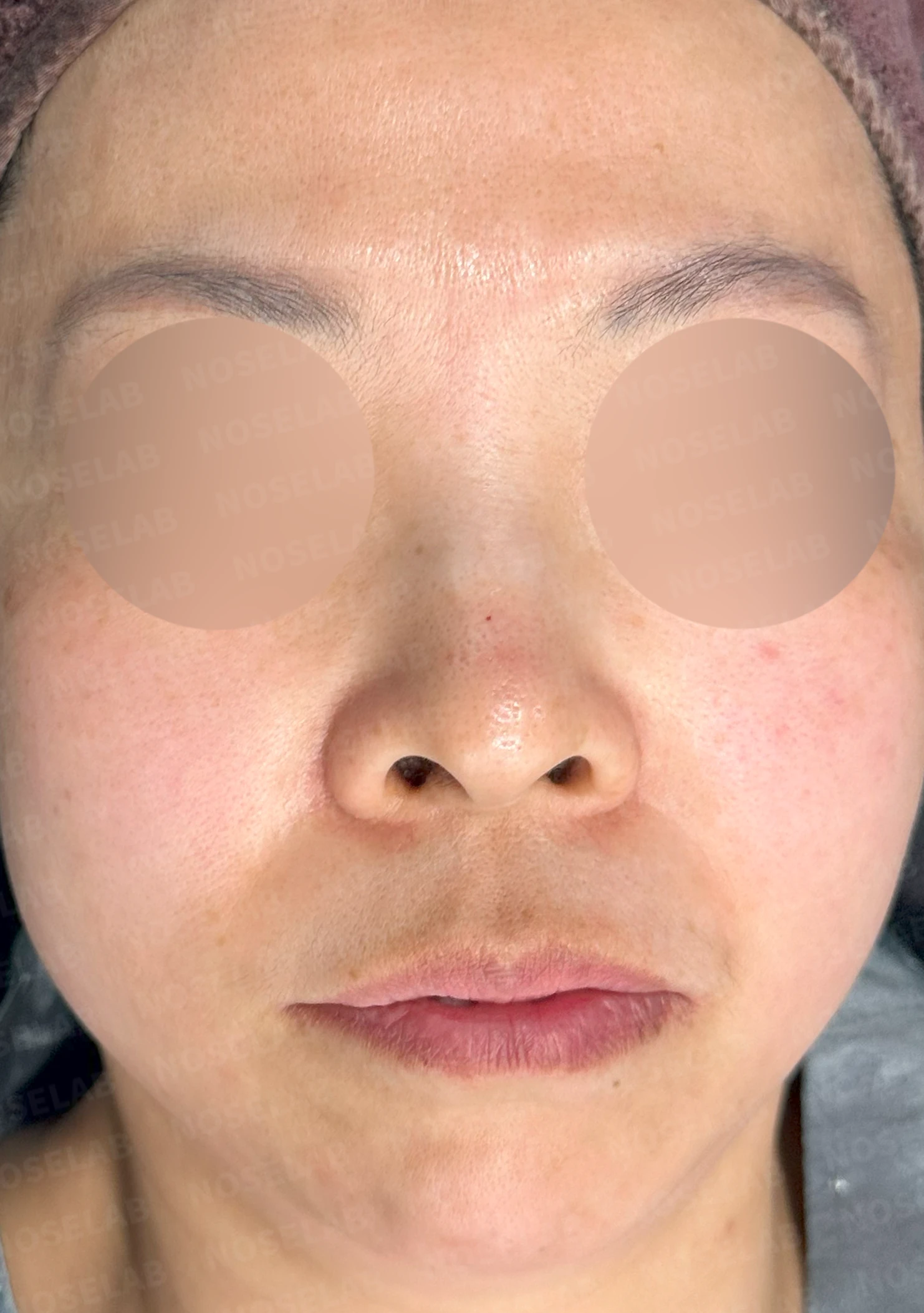 들창코에서 콧구멍이 많이 보이는 이유, 코끝 위치 교정은 어떻게 하나 — 수술 전 / 수술 직후 0일 직후 사진은 부기가 있는 상태로 최종 결과와 다를 수 있습니다.