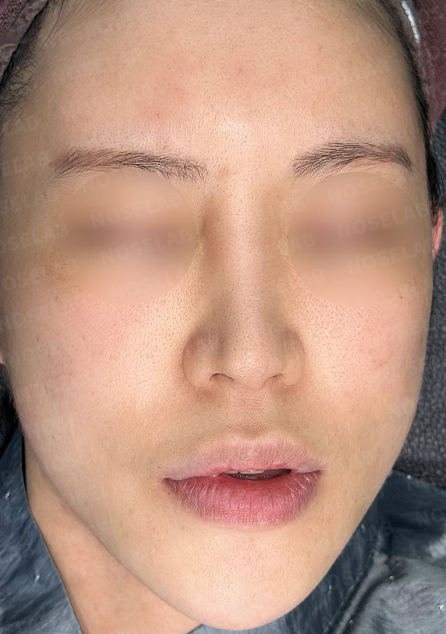 높은 콧대 시작점을 낮추는 방법 — 수술 전 / 수술 직후 0일 직후 사진은 부기가 있는 상태로 최종 결과와 다를 수 있습니다.