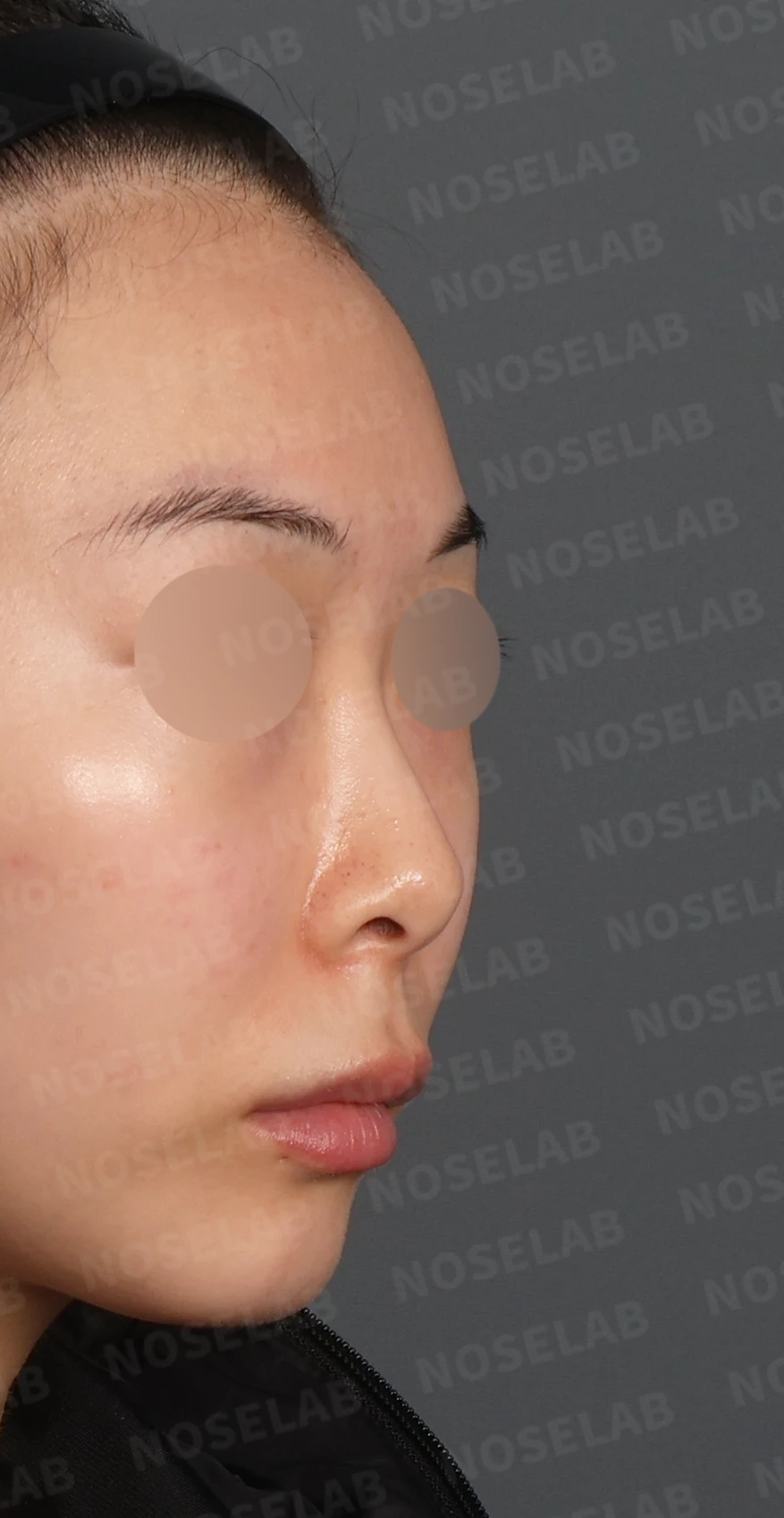 작고 낮은 코, 자가늑연골로 비순각 교정까지 한 번에 완성한 비개방 코성형 — 디자인 상담 우측 측면, 비스듬한 측면, 비공 사진입니다.